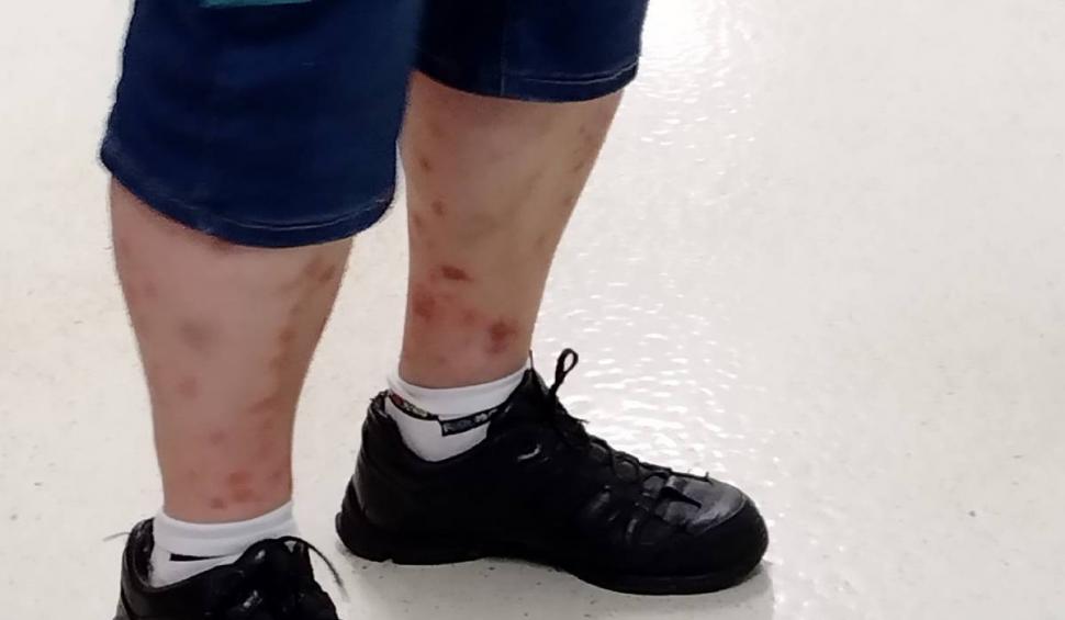 Ciupită de ploșnițe într-un hotel din România | O turistă a ajuns la spital după ce a fost într-o staţiune balneară 790385