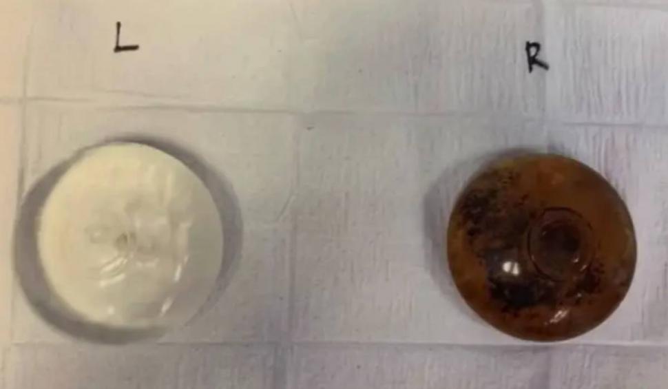 Femeie, la un pas de moarte din cauza unei operații estetice. Ce au descoperit medicii când i-au scos implanturile 795888