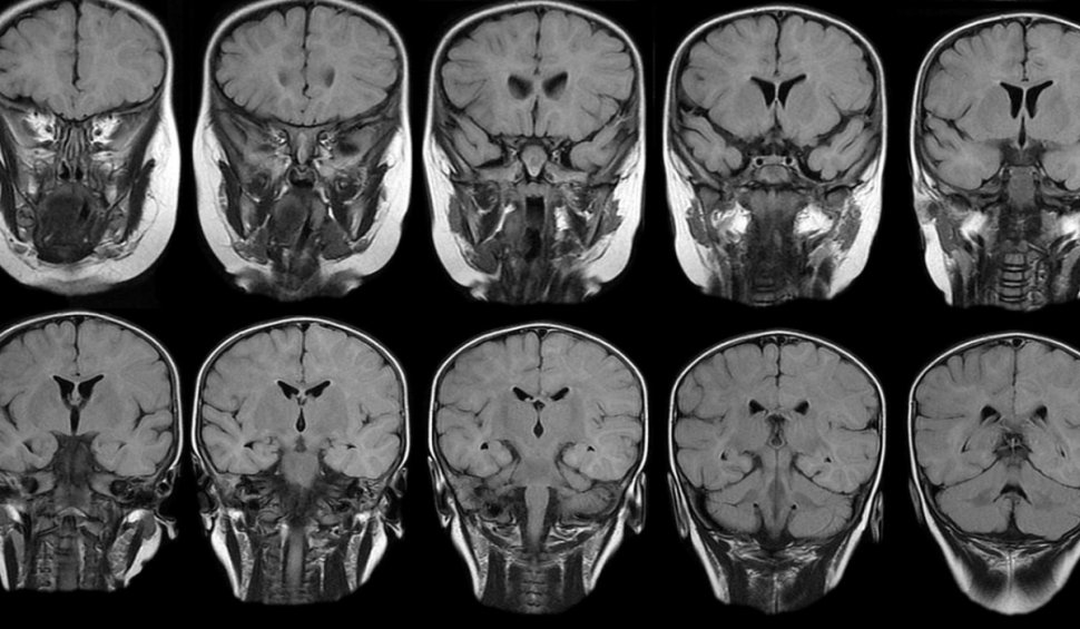Anomalii semnificative la creier, în cazul celor vindecați de COVID-19, descoperite de oamenii de știință