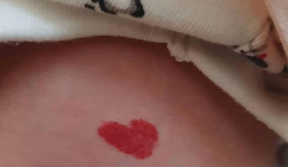Semnul cu care o fetiță s-a născut pe corp, în luna iubirii. Medicii au rămas uluiți: "Au crezut că se va estompa, dar nu a dispărut"  816720