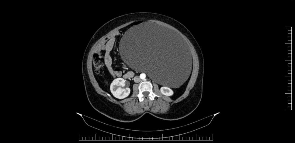 Chist ovarian de 4,5 kilograme, extirpat cu succes de la o pacientă la un spital din Sibiu 823412