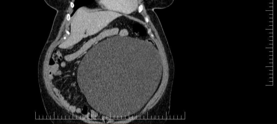 Chist ovarian de 4,5 kilograme, extirpat cu succes de la o pacientă la un spital din Sibiu 823413