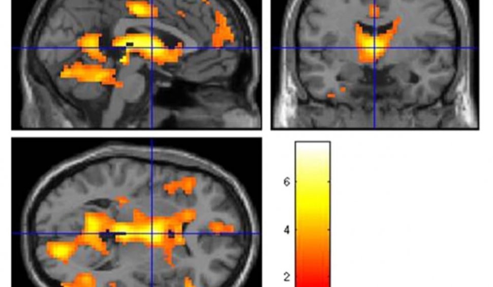 Un medic neurolog român arată cum este afectat creierul de gelozie. Ce a descoperit când a analizat RMN-urile funcționale