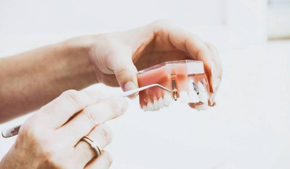 Descoperă confortul și calitatea implanturilor dentare moderne: Un tratament sigur și nedureros pentru un zâmbet sănătos și frumos