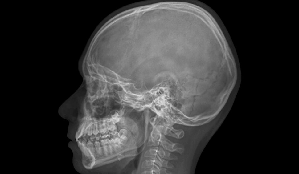 Un bărbat căruia i-a trecut un glonț prin creier a supraviețuit și a descoperit o față stranie a lumii. "Pacientul M" a determinat o revoluție în medicină 