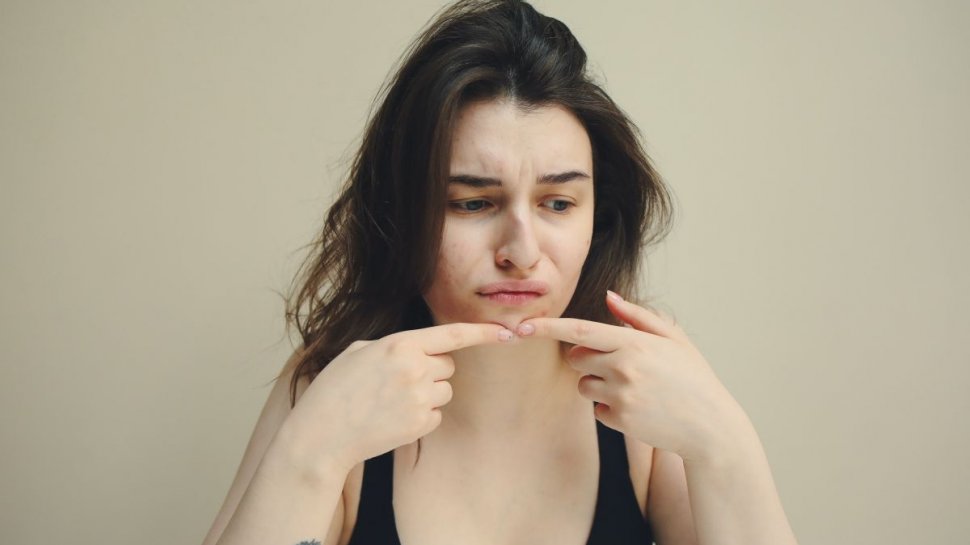 Diferența dintre acnee și ”banalele” coșuri. Pericolul când tratăm acneea acasă fără recomandare medicală