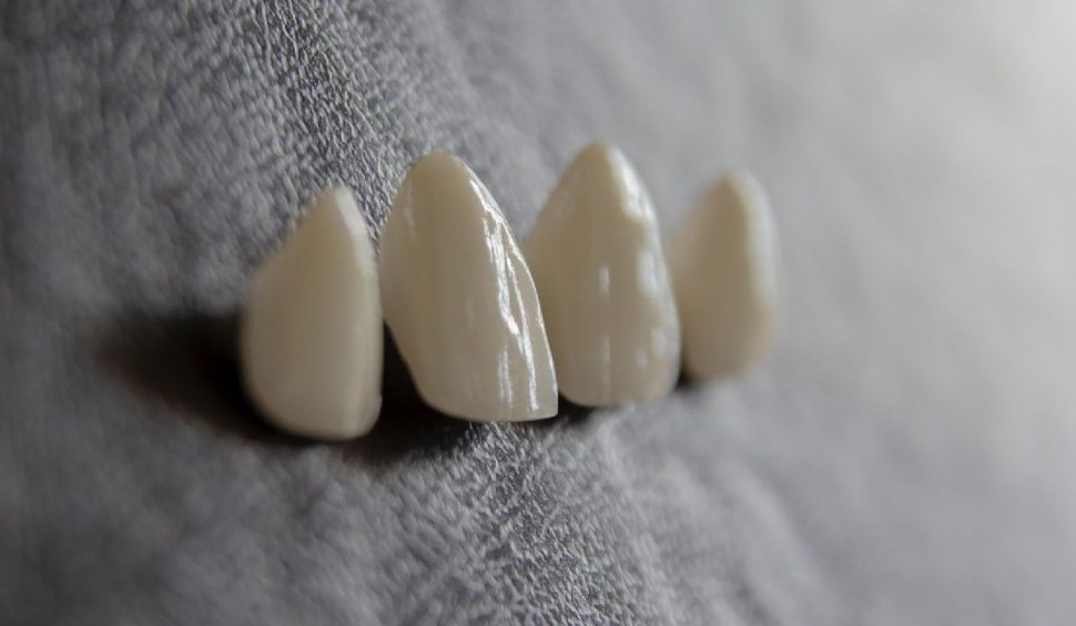Ce presupune consultația în vederea unui implant dentar