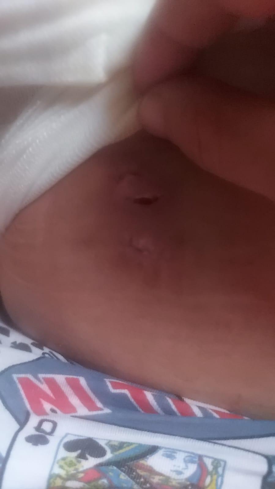 Un medic de la spitalul din Urlați a cusut în piciorul unui tânăr mânerul de frână de la bicicletă și l-a trimis acasă 850116