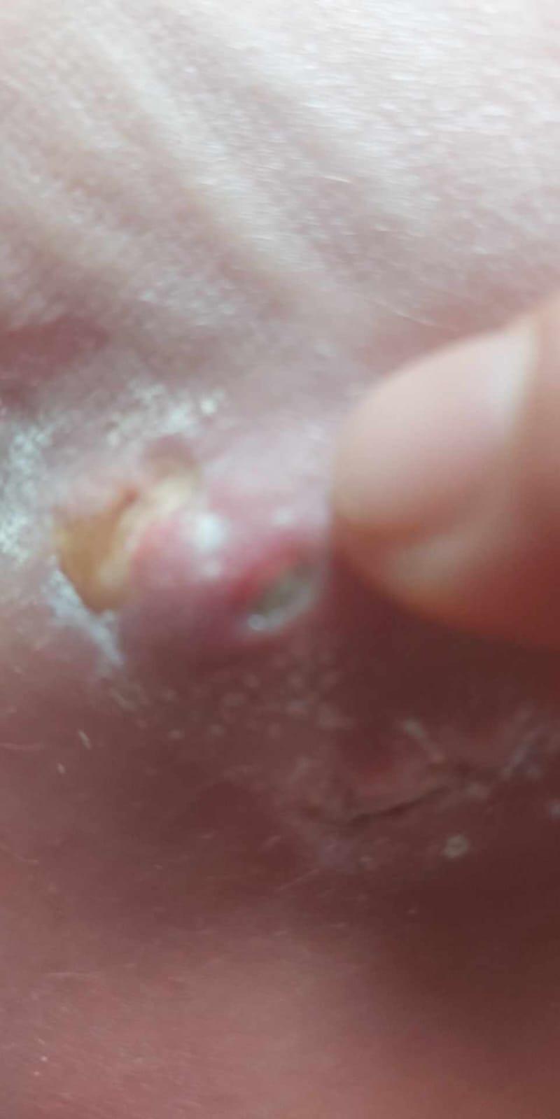 Un medic de la spitalul din Urlați a cusut în piciorul unui tânăr mânerul de frână de la bicicletă și l-a trimis acasă 850117