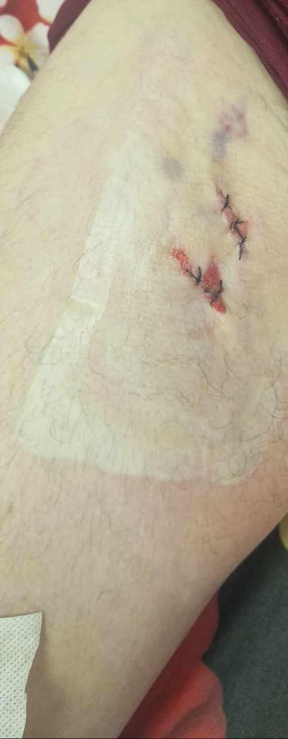 Un medic de la spitalul din Urlați a cusut în piciorul unui tânăr mânerul de frână de la bicicletă și l-a trimis acasă 850118