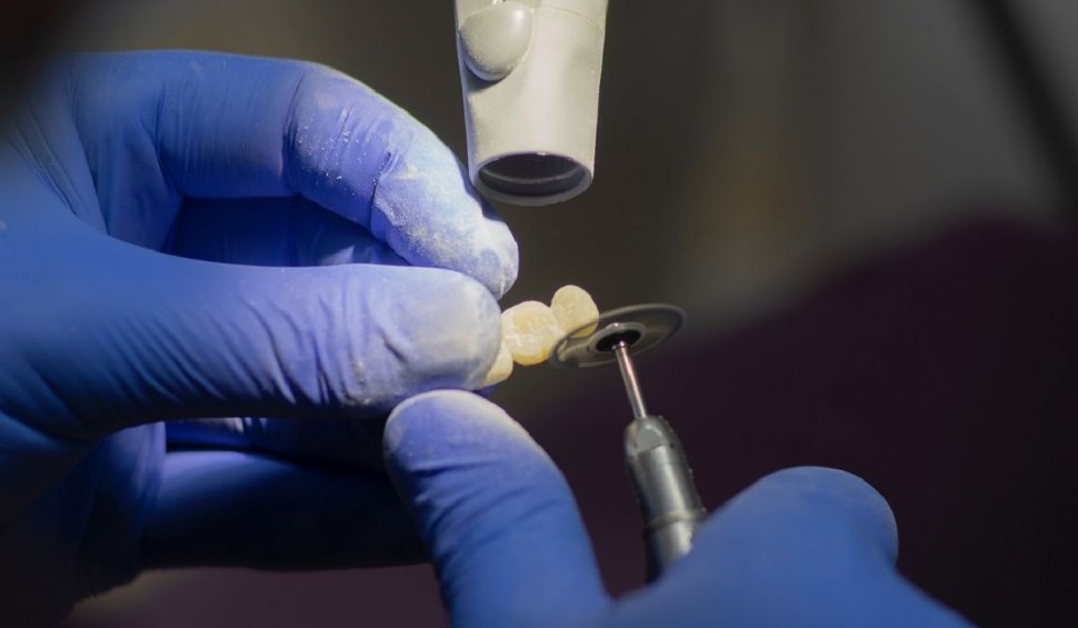Cât de recomandat este implantul dentar pentru înlocuirea dinților lipsă? Ce tip de implant ți se potrivește