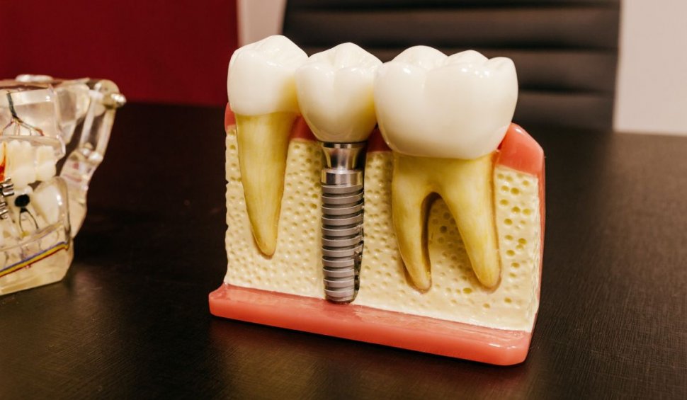 Afecțiuni orale care pot necesita tratament cu implant dentar