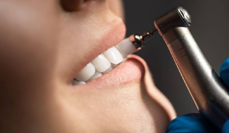 Detartrajul dentar, cea mai eficientă soluție în combaterea plăcii bacteriene