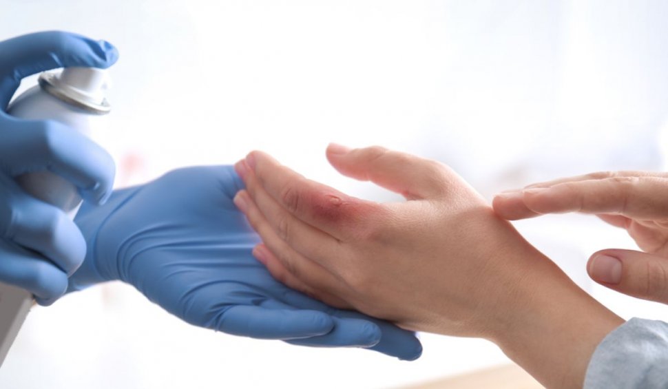 SUA  a aprobat primul tratament împotriva infecțiilor virale ale pielii