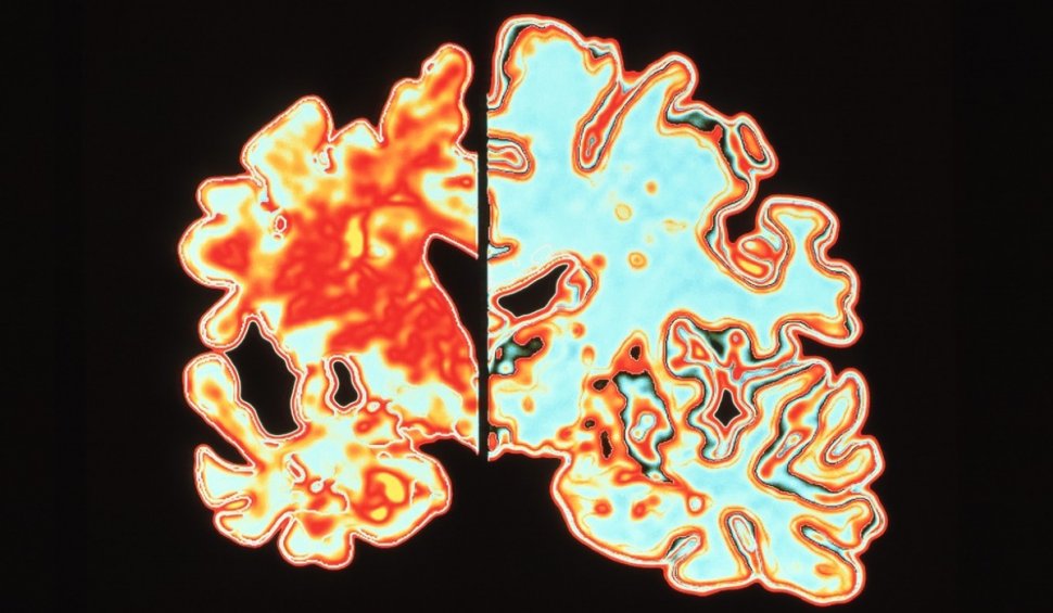 "Am rămas cu gura căscată": Un tratament nou pentru Alzheimer, cu ultrasunete, prezintă rezultate uluitoare în testele clinice