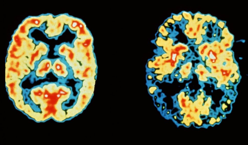 S-a descoperit o nouă metodă de a descoperi boala Alzheimer, cu până la 20 de ani înainte de primele simptome: "Se produc modificări fiziologice"
