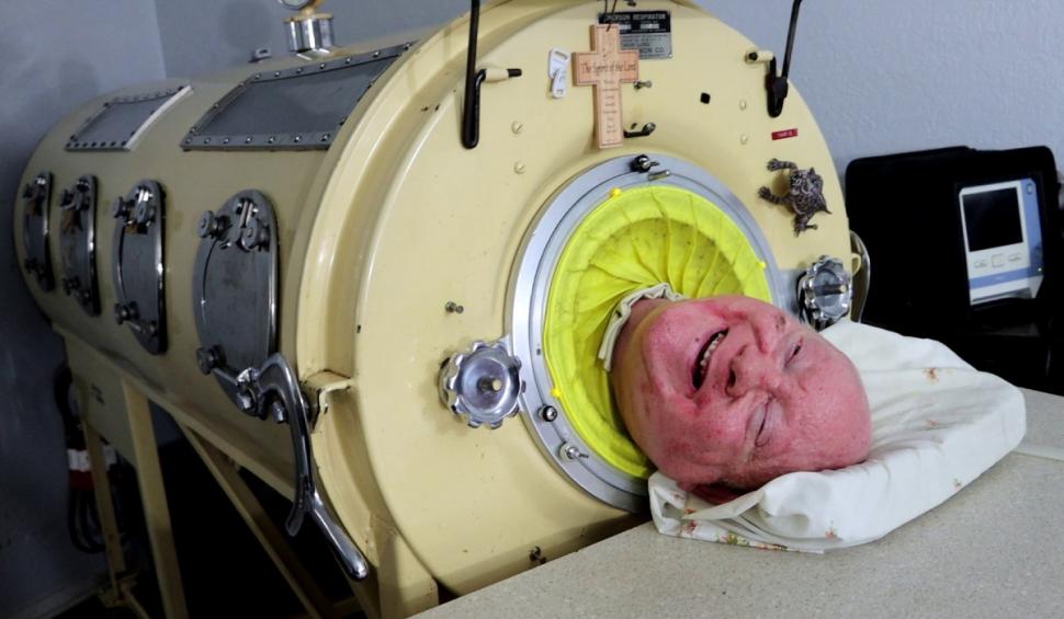 A murit Paul Alexander, bărbatul care și-a trăit aproape toată viața într-un plămân de oțel 891681