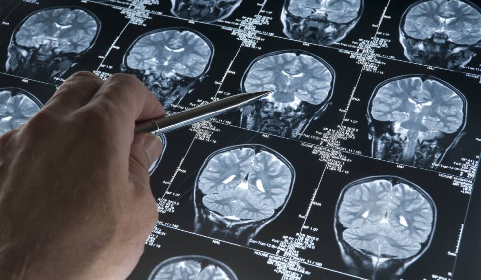 Un bărbat care suferea de migrene puternice a descoperit că avea tenii în creier. Cauza ar fi consumul de slănină insuficient gătită