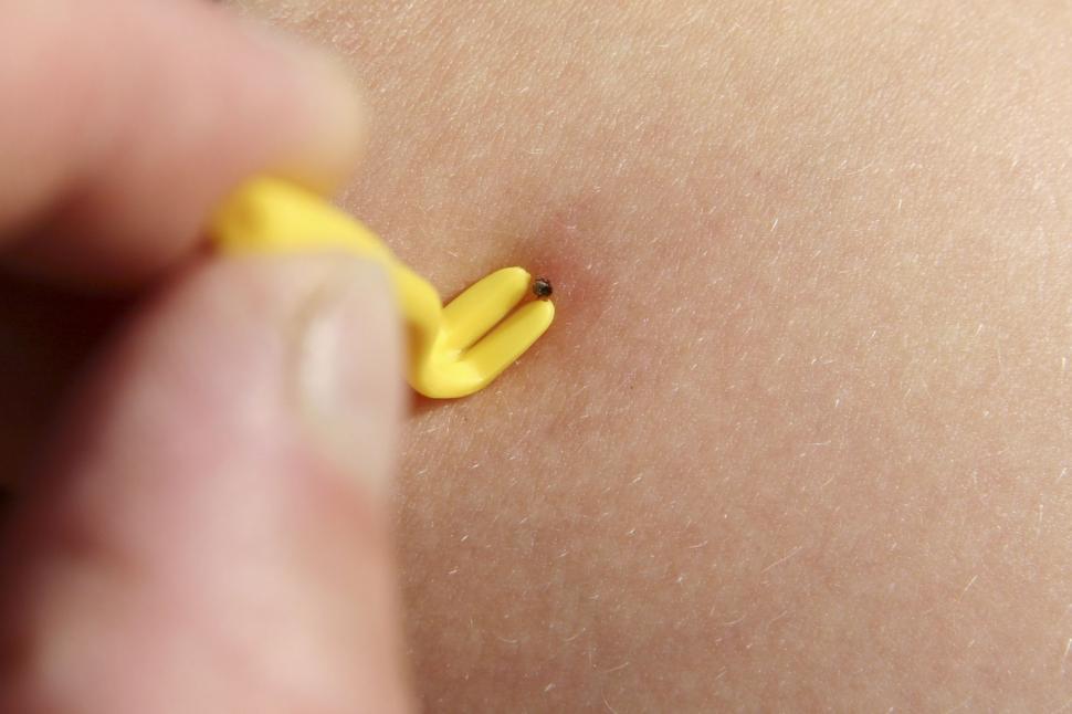 Cum se scoate corect o căpușă din piele. Metoda prin care poate fi îndepărtată în siguranță 893687