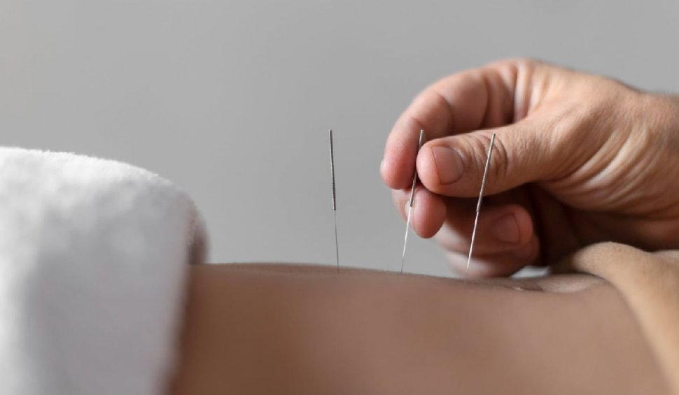 Acupunctura, o metodă terapeutică antică. Beneficii şi afecţiuni tratate