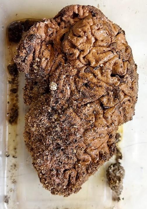 Colecționara de creiere antice: Povestea tinerei care a studiat peste 4.400 de organe. Totul a început cu câteva migrene îngrozitoare 930318