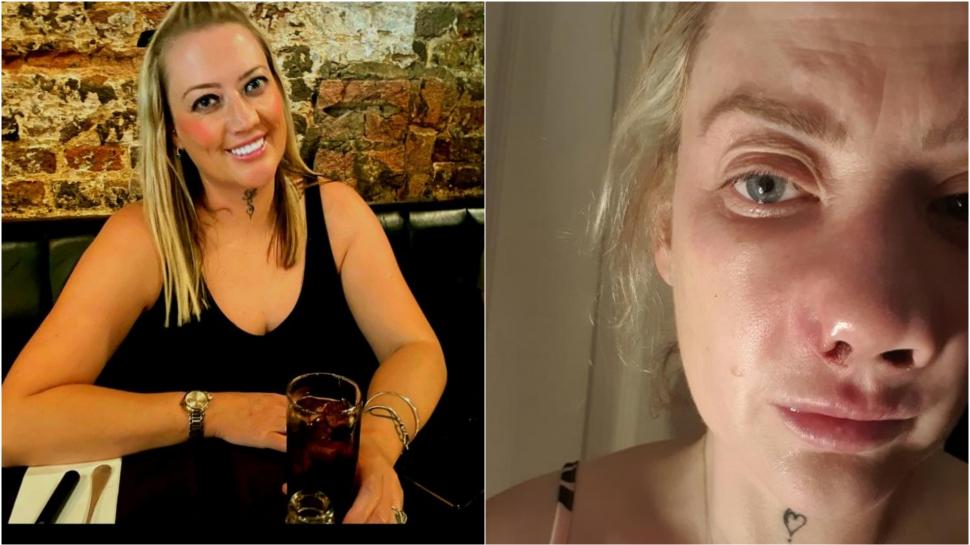 O femeie s-a dus în Turcia să-și facă dantura pe bani puțini. A fost desfigurată și suferă de dureri imposibile 977971