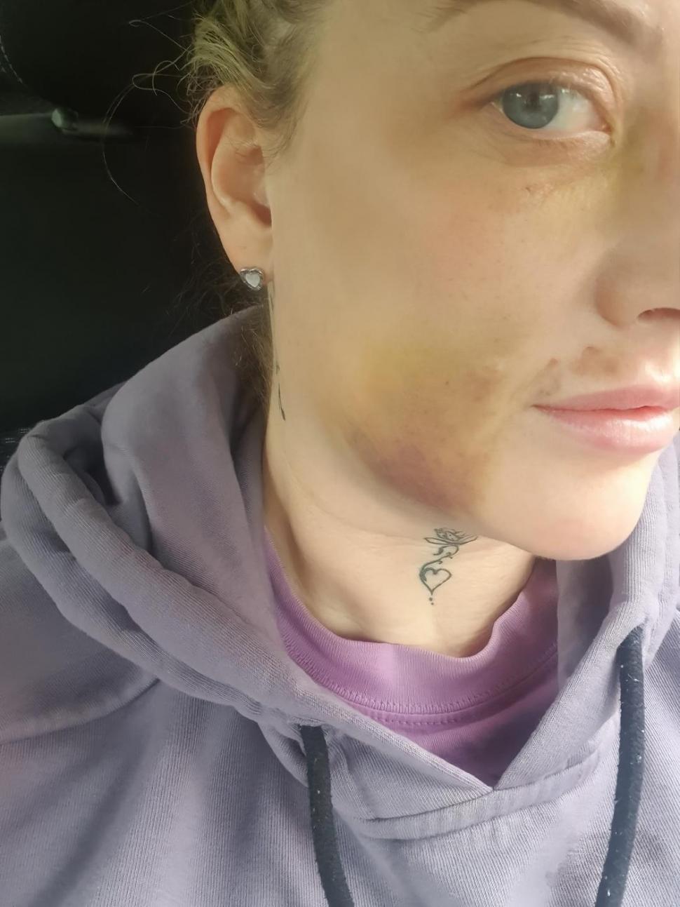 O femeie s-a dus în Turcia să-și facă dantura pe bani puțini. A fost desfigurată și suferă de dureri imposibile 977972