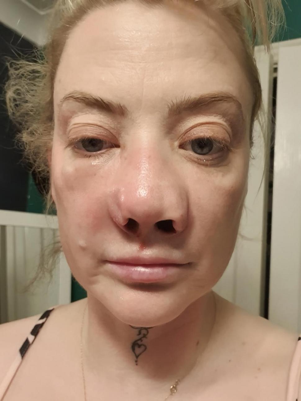 O femeie s-a dus în Turcia să-și facă dantura pe bani puțini. A fost desfigurată și suferă de dureri imposibile 977973