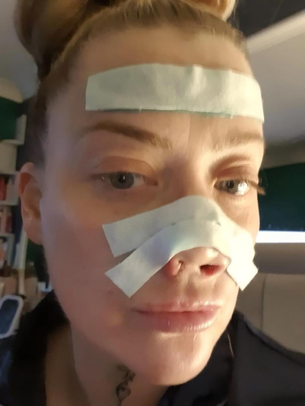 O femeie s-a dus în Turcia să-și facă dantura pe bani puțini. A fost desfigurată și suferă de dureri imposibile 977975