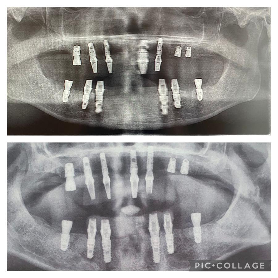 O femeie s-a dus în Turcia să-și facă dantura pe bani puțini. A fost desfigurată și suferă de dureri imposibile 977977