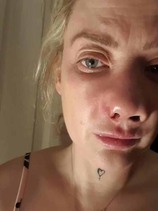 O femeie s-a dus în Turcia să-și facă dantura pe bani puțini. A fost desfigurată și suferă de dureri imposibile 977979