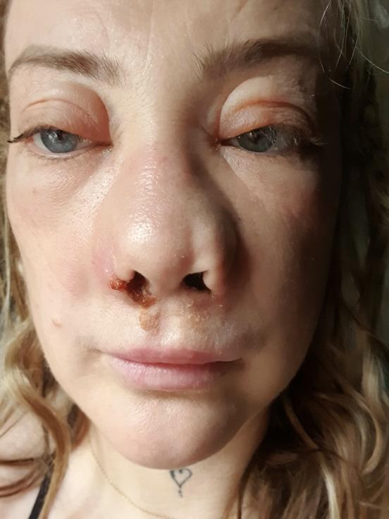 O femeie s-a dus în Turcia să-și facă dantura pe bani puțini. A fost desfigurată și suferă de dureri imposibile 977981