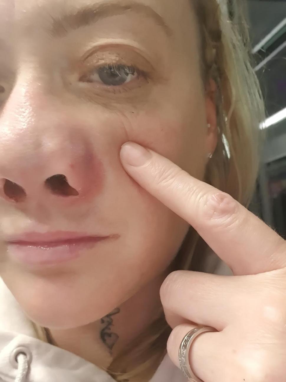 O femeie s-a dus în Turcia să-și facă dantura pe bani puțini. A fost desfigurată și suferă de dureri imposibile 977984