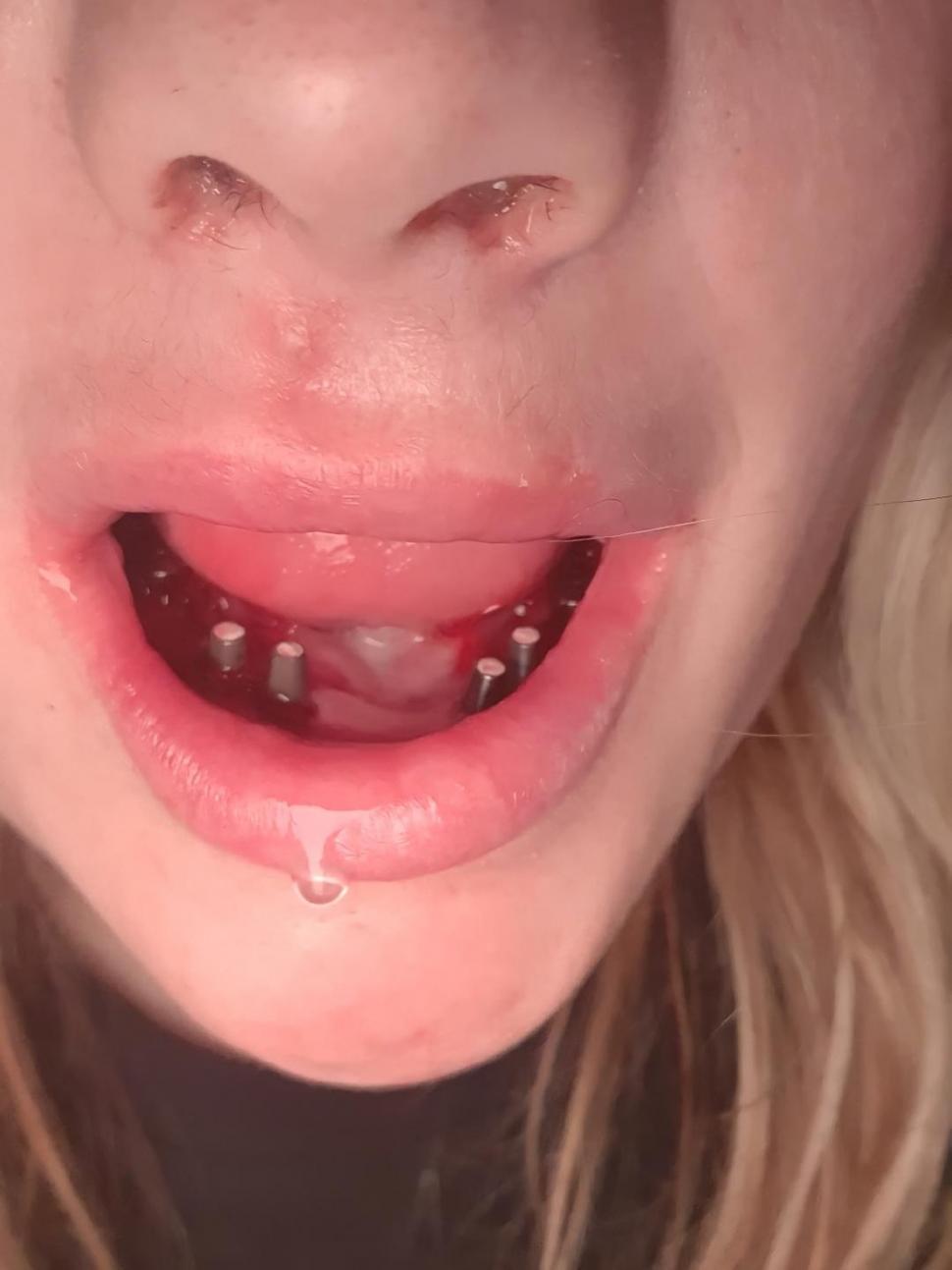 O femeie s-a dus în Turcia să-și facă dantura pe bani puțini. A fost desfigurată și suferă de dureri imposibile 977986