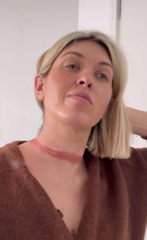 O vedetă de pe internet a povestit că a fost aproape de moarte din cauza unui accesoriu de la rochie și a postat imagini șocante  999887