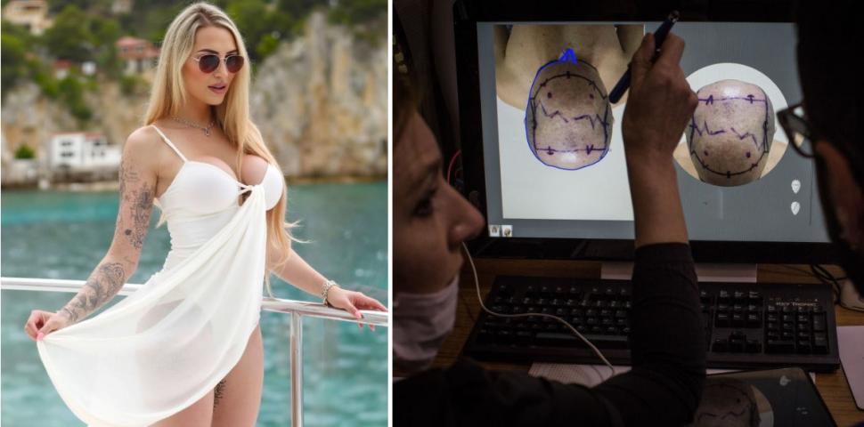 Implantul de păr, noua tendință în rândul femeilor. Rata lor de succes e complicată, dar o culturistă a ales să facă intervenţia 1029600