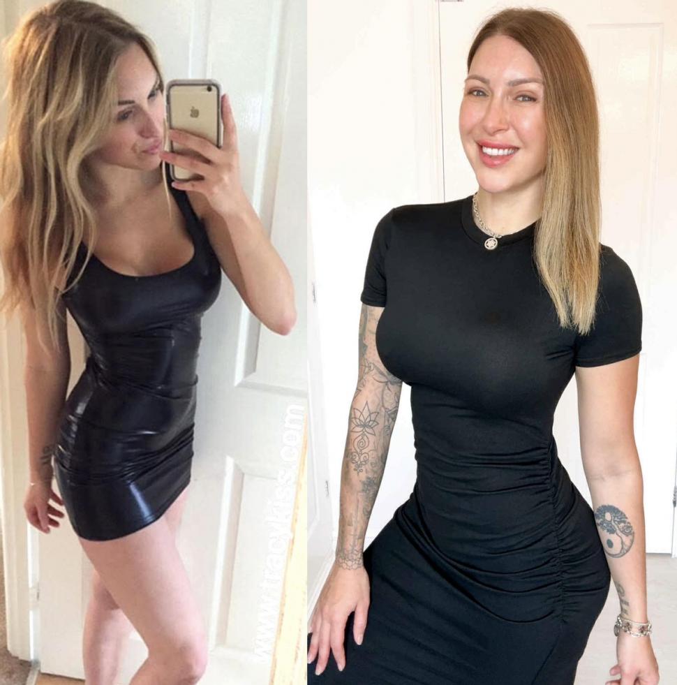 Implantul de păr, noua tendință în rândul femeilor. Rata lor de succes e complicată, dar o culturistă a ales să facă intervenţia 1029606