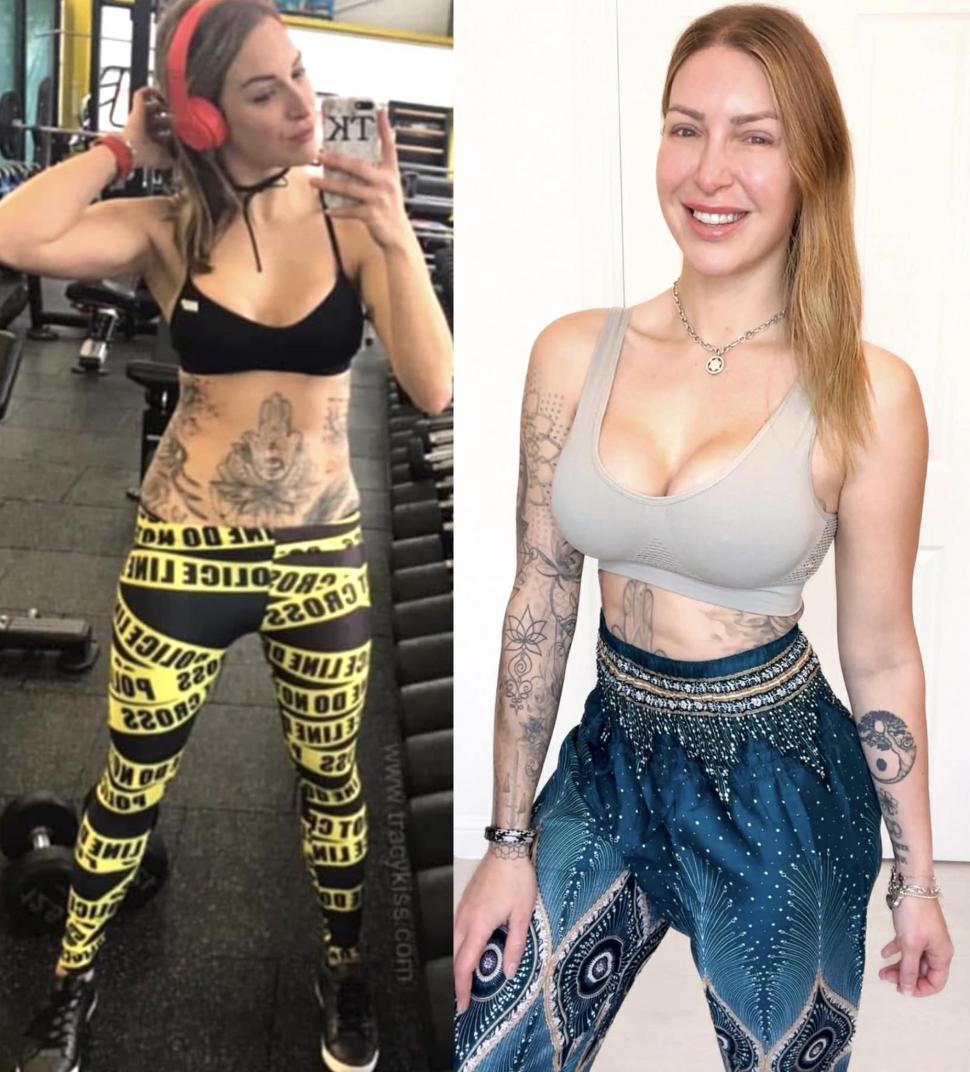 Implantul de păr, noua tendință în rândul femeilor. Rata lor de succes e complicată, dar o culturistă a ales să facă intervenţia 1029609