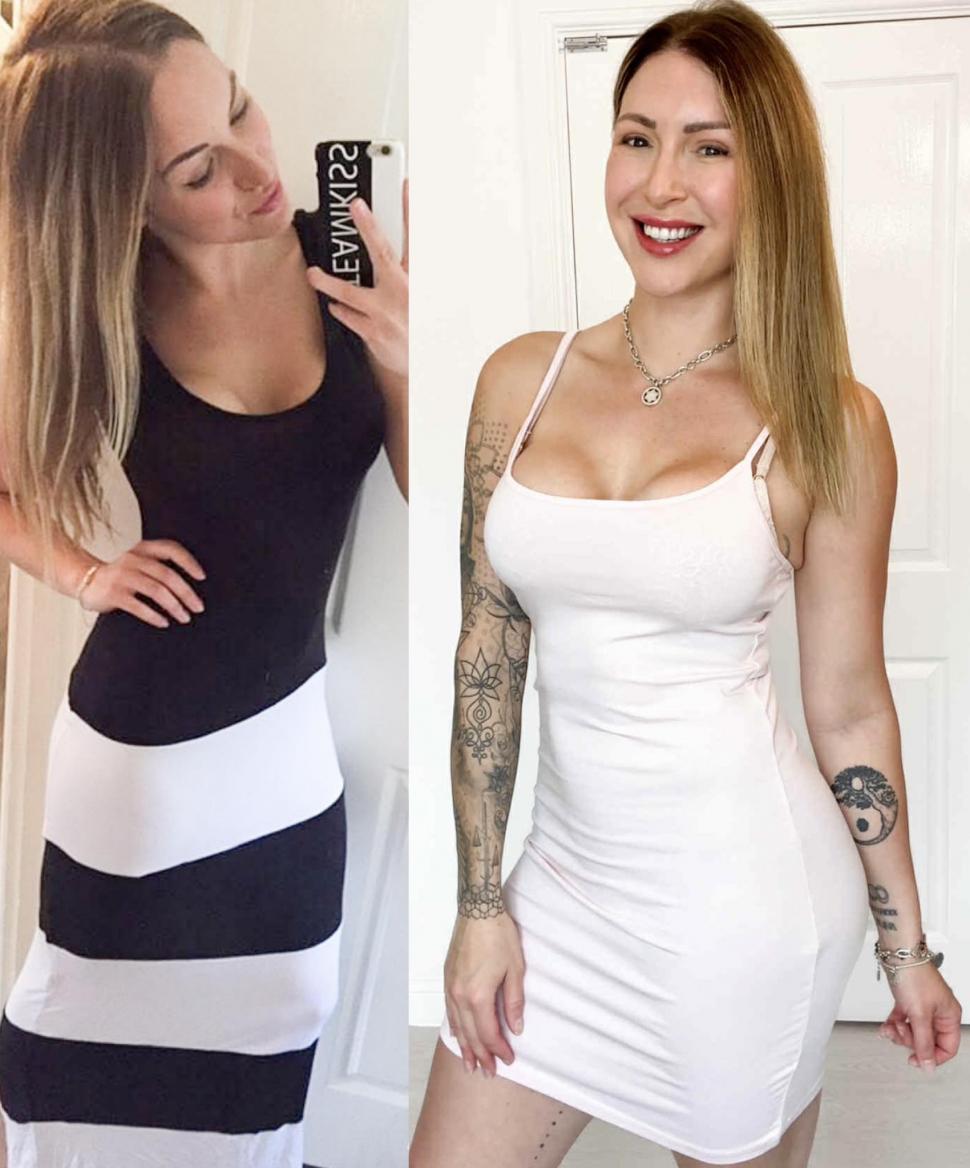 Implantul de păr, noua tendință în rândul femeilor. Rata lor de succes e complicată, dar o culturistă a ales să facă intervenţia 1029611