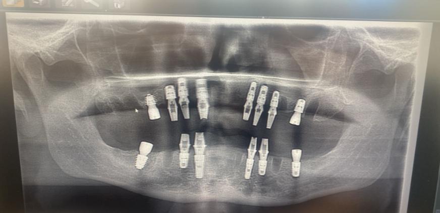 Un bărbat care a crezut că-și repară toată dantura cu 5.000 de euro în Turcia s-a întors acasă fără niciun dinte în gură 1061583