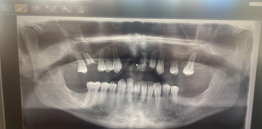 Un bărbat care a crezut că-și repară toată dantura cu 5.000 de euro în Turcia s-a întors acasă fără niciun dinte în gură 1061584