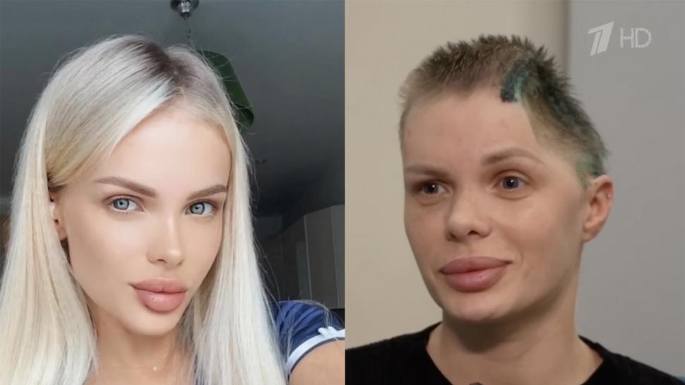 Un oligarh rus a făcut un şoc şi a murit când a aflat ce riscă pentru că și-a bătut iubita model. Ea a rămas fără jumătate din craniu 1066469