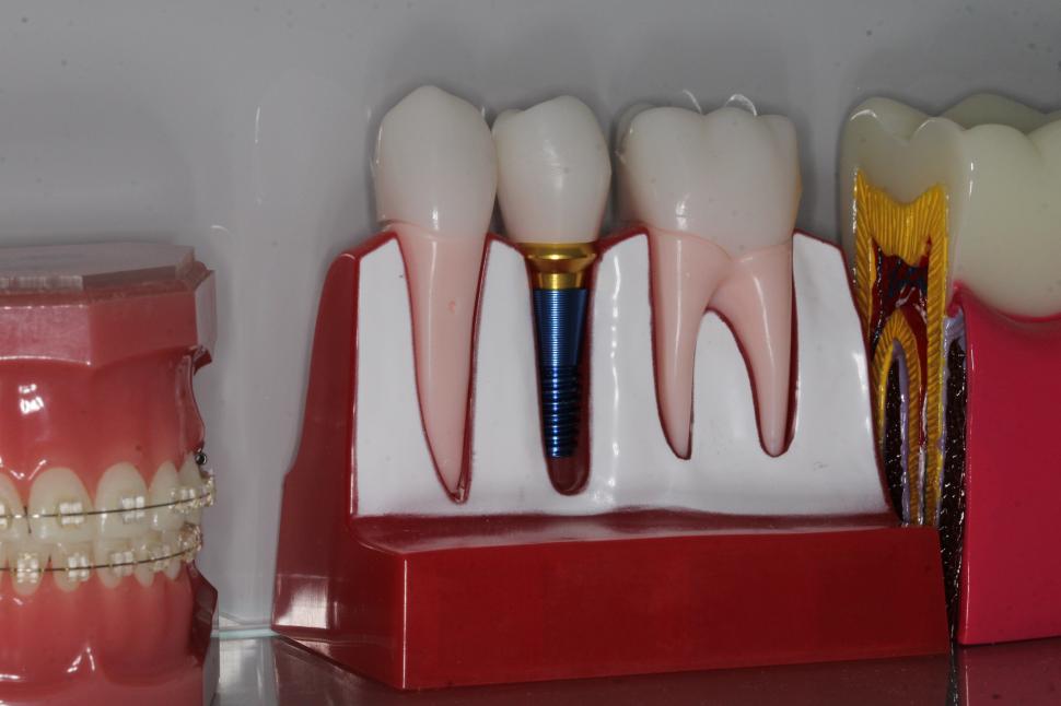 Cât costă un implant dentar în București și ce influențează prețul? Explicații de la medicii Dental Science, clinica din sectorul 6 1092947