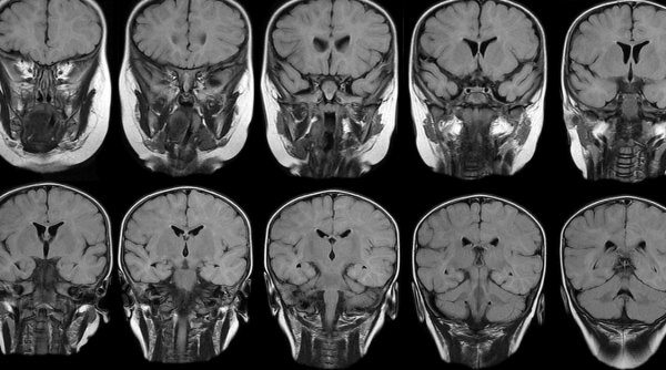 Anomalii semnificative la creier, în cazul celor vindecați de COVID-19, descoperite de oamenii de știință