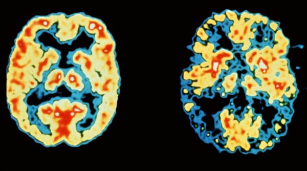 S-a descoperit o nouă metodă de a descoperi boala Alzheimer, cu până la 20 de ani înainte de primele simptome: 