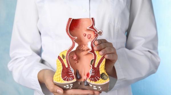 supozitoare pentru hemoroizi diferentele intre optiunile disponibile pe piata