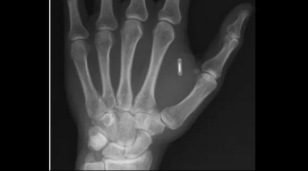 un barbat si a implantat un cip in mana pentru trucuri de magie dar a uitat parola am crezut ca o sa fie amuzant