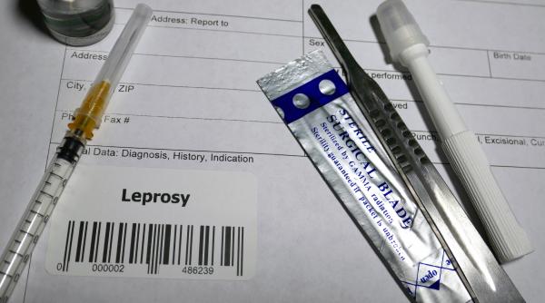 Cum se tratează lepra și cât timp e contagioasă. Medic infecționist: „Tratamentul poate dura până la doi ani”