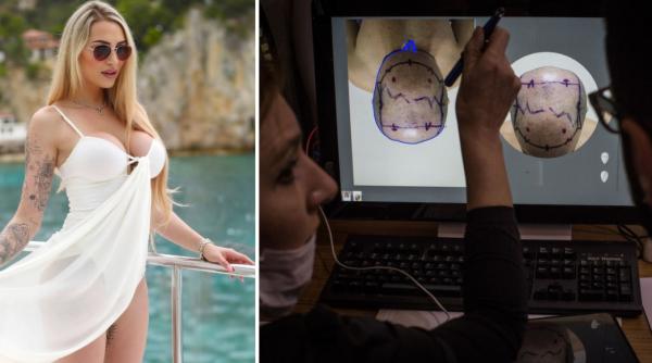 implantul de par noua tendinta in randul femeilor rata lor de succes e complicata dar o culturista a ales sa faca interventia