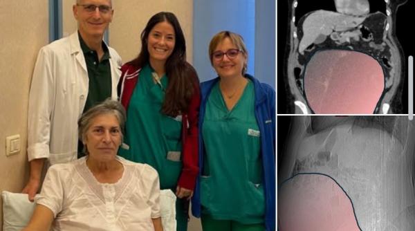 tumoare ovariana de 6 kilograme extirpata de la o femeie in italia